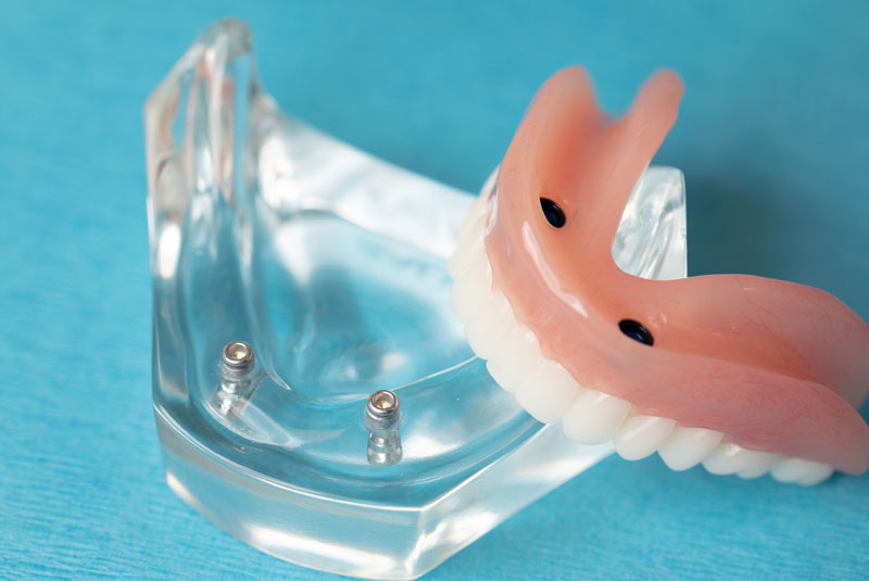 implant supported dentures